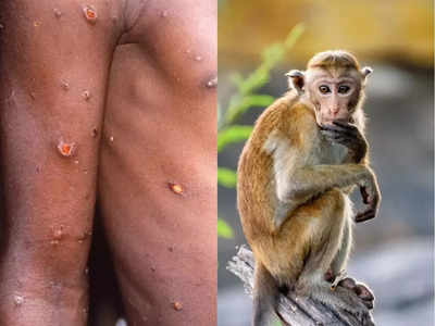 Monkeypox virus: 58 देशों में फैला मंकीपॉक्स, WHN ने महामारी घोषित किया, जानिए आगे क्या खतरा है?