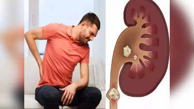 kidney stones: கிட்னி ஸ்டோன் அபாயம் யாருக்கு தெரியுமா.. ஆரம்ப கால அறிகுறி இப்படிதான் இருக்குமாம்!