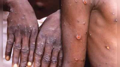 Monkeypox: சமூக பரவலாக குரங்கு அம்மை? - உலக சுகாதார அமைப்பு விளக்கம்!