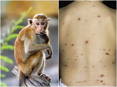 Monkeypox Virus: আতঙ্কের নতুন নাম মাঙ্কিপক্স ভাইরাস! এর লক্ষণ, চিকিৎসা, প্রতিরোধের উপায় জানাচ্ছেন চিকিৎসক