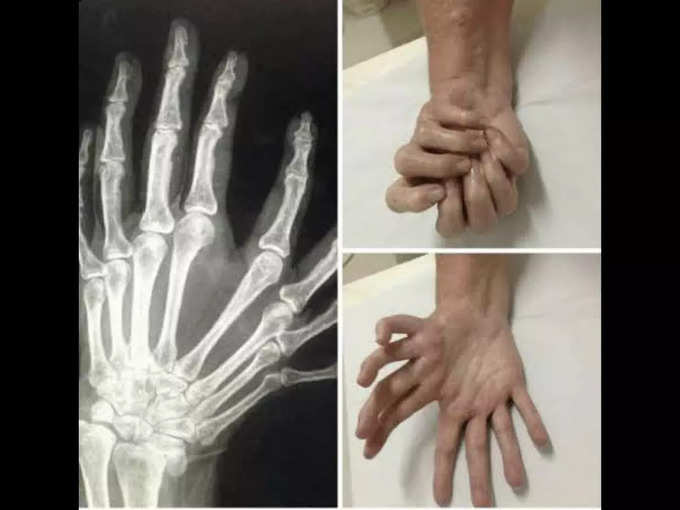 దీన్ని మిర్రర్ హ్యాండ్ సిండ్రోమ్ (Mirror Hand Syndrome) అంటారు. ఇప్పటివరకూ ప్రపంచంలో వంద మంది కంటే తక్కువ మందికే ఇది వచ్చింది. ఇది ఎందుకు వస్తుందో తెలియలేదు