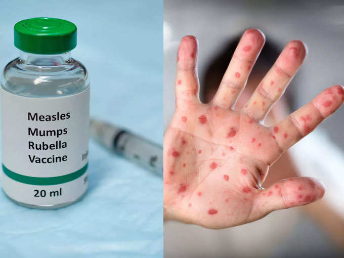 ​தட்டம்மை (Measles)