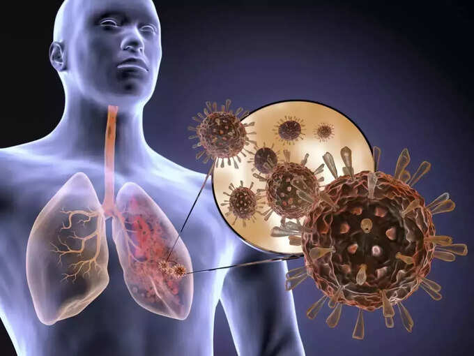 ​சுவாச ஒத்திசைவு வைரஸ் (Respiratory Syncytial Virus - RSV)