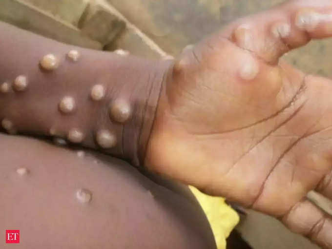 ​குரங்கு காய்ச்சல் நோய் (Monkeypox)