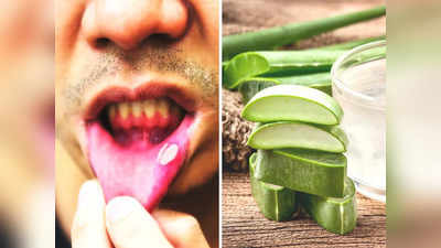 Mouth Ulcer Home Remedy: पेट में गर्मी समेत इन 5 गंभीर बीमारियों का संकेत है मुंह में छाले, ये 5 चीजों को खाने से बचेगी डॉक्टर की फीस