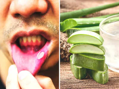 Mouth Ulcer Home Remedy: पेट में गर्मी समेत इन 5 गंभीर बीमारियों का संकेत है मुंह में छाले, ये 5 चीजों को खाने से बचेगी डॉक्टर की फीस