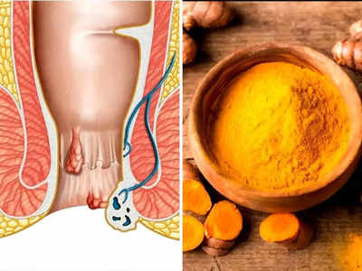 Piles Home Remedy: किचन में रखी ये पीली चीज है खूनी बवासीर का रामबाण इलाज, तुरंत राहत के लिए इन 4 तरीकों से करें इस्तेमाल