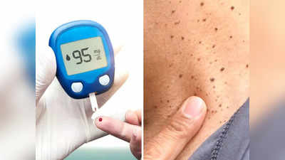 Skin Sign Of Diabetes: खून में बढ़ रहे शुगर से बिगड़ सकती है त्वचा की सूरत, मस्से समेत इन 5 लक्षणों को गलती से भी न करें इग्नोर