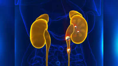 kidney stones: சிறுநீரக கல் பிரச்சினையால அவதிப்படறீங்களா? தினமும் இதுல ஒரு பானத்தை குடிங்க...