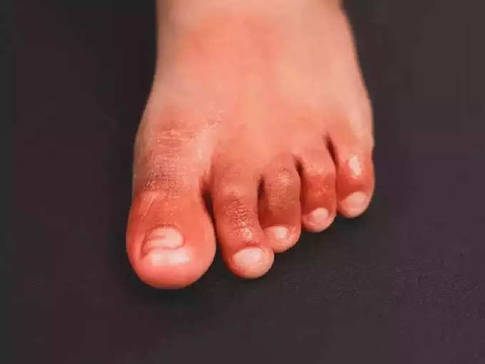 कोविड टोएज (COVID toes)