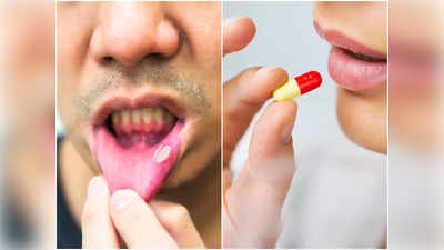Mouth Ulcer: মুখের ভিতর ঘা কি ভিটামিনের অভাবে হয়? জানুন চিকিৎসকের মত