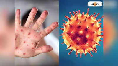 Monkeypox virus: বড় স্বস্তি, উপসর্গ থাকলেও মাঙ্কিপক্সে আক্রান্ত নয় কলকাতার যুবক