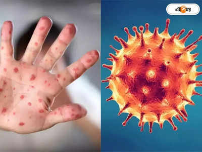 Monkeypox Virus: ভারতে মাঙ্কিপক্স আতঙ্ক, কেরালায় ব্যক্তির শরীরে মিলল উপসর্গ