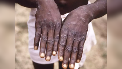 Monkeypox Outbreak: മങ്കി പോക്സ്: കൊവിഡ് പോലെ മഹാമാരിയാകുമോ? മൃഗങ്ങളിൽ നിന്ന് മനുഷ്യരിലേക്കുള്ള 60% രോഗങ്ങൾ വർദ്ധിക്കുമെന്ന് മുന്നറിയിപ്പ്