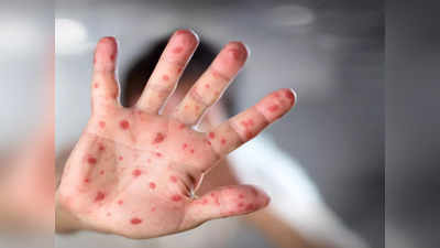 Monkeypox in India: भारत में घुसा मंकीपॉक्स, केरल में मिला पहला मामला, इन 6 लक्षणों पर रखें कड़ी नजर