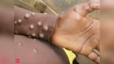 Monkeypox infection: இந்தியாவில் நுழைந்தது மங்கிபாக்ஸ் தொற்று - கேரளாவில் ஒரு நபருக்கு பாதிப்பு