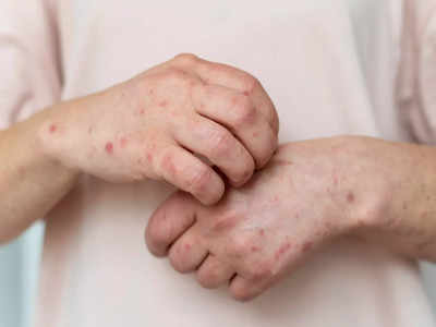 ચોમાસામાં Skin allergy દૂર કરવા અજમાવો આ ઘરેલૂ ઉપાય, ડોક્ટર પાસેથી ઇન્ફેક્શન દૂર કરવાના જાણો ઉપચાર  