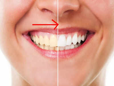 Teeth Whitening: দু’দিনেই হলুদ ছোপ হবে উধাও! ঝকঝকে সাদা দাঁত পেতে কাজে লাগান এই ঘরোয়া টোটকা