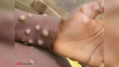 monkeypox: மங்கிபாக்ஸ் தொற்றிலிருந்து வேகமாக மீள சாப்பிட வேண்டிய ஐந்து உணவுகள் என்னென்ன...