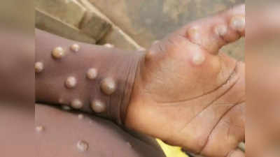Monkeypox: বিদেশ ভ্রমণের কোনও ইতিহাস নেই, দিল্লিতে চতুর্থ মাঙ্কিপক্স আক্রান্তের হদিশ