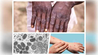 Delhi Monkeypox News: दिल्‍ली में मंकीपॉक्‍स की दस्‍तक, बिना इंटरनैशनल ट्रैवल के मरीज हुआ संक्रमित