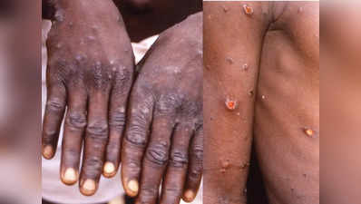 Monkeypox: ఢిల్లీలో మంకీపాక్స్.. దేశంలో నాలుగుకి చేరిన కేసులు.. అలర్ట్ అయిన WHO