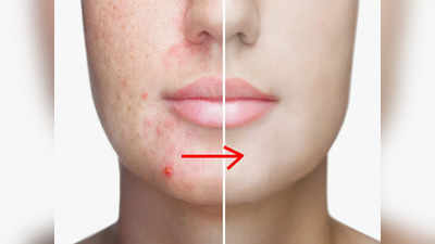 Pimple Home Remedies: ব্রণ থেকে মুক্তি পাবেন চিরতরে! দিনে মাত্র এই ৩টি কাজ করলেই হবে