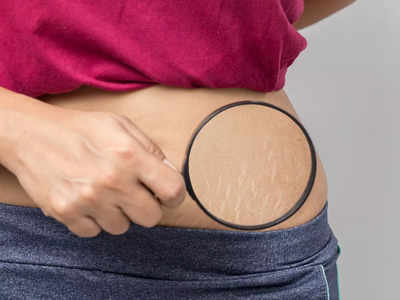 Stretch Mark Removal : स्ट्रेच मार्क्स को कम कर सकती हैं ये Cream, फटी हुई स्किन धीरे-धीरे होगी गायब