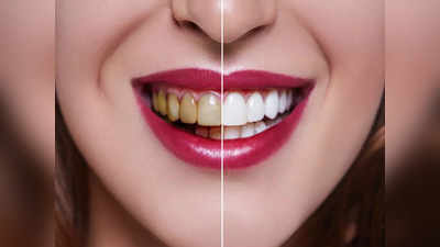 Teeth whitening at home: 1 चुटकी नमक+ 2 बूंद सरसों तेल= दांतों का पीलापन, बदबू, खून आना सब एक साथ गायब
