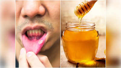 Mouth Ulcer Home Remedies: মুখের ঘায়ের জ্বালা, যন্ত্রণা মিটে যাবে নিমেষে! শুধু এই ঘরোয়া টোটকা ব্যবহার করে দেখুন