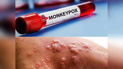 Monkeypox : दिल्ली में एडमिट मंकीपॉक्स के संदिग्ध मरीज ने की थी विदेश यात्रा, सामने आई जानकारी