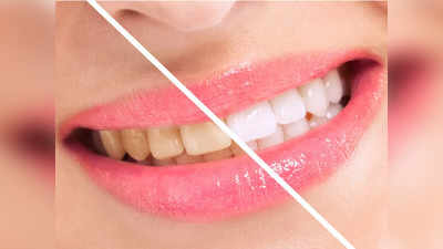 Teeth Colour: പല്ലിലെ മഞ്ഞപ്പ് കളയുവാന്‍ എളുപ്പവഴിയുണ്ട് മക്കളേ!