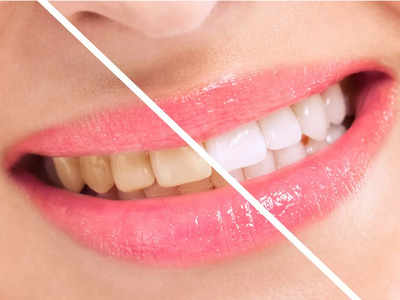 Teeth Colour: പല്ലിലെ മഞ്ഞപ്പ് കളയുവാന്‍ എളുപ്പവഴിയുണ്ട് മക്കളേ!