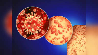 Monkeypox prevention: भारतीय डॉक्टरों ने बताए मंकीपॉक्स से बचाव के 6 आसान और असरदार उपाय