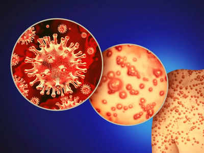 Monkeypox prevention: भारतीय डॉक्टरों ने बताए मंकीपॉक्स से बचाव के 6 आसान और असरदार उपाय
