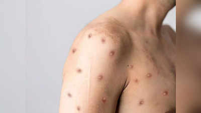 Monkeypox prevention: ఈ జాగ్రత్తలు తీసుకుంటే.. మంకీపాక్స్‌ సోకదు..!