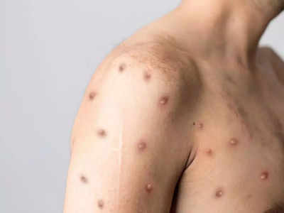 Monkeypox prevention: ఈ జాగ్రత్తలు తీసుకుంటే.. మంకీపాక్స్‌ సోకదు..!