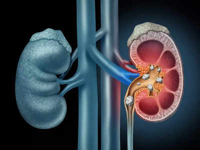 Kidney Stone Symptoms: এই লক্ষণেই বুঝে যান কিডনিতে স্টোন হয়ে জমছে Uric Acid! জানাচ্ছেন চিকিৎসক