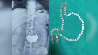 Jodhpur News: पेट है या गुल्लक... जोधपुर में पेट दर्द लेकर अस्पताल पहुंचा युवक, निकले एक या दो नहीं कुल 63 सिक्के