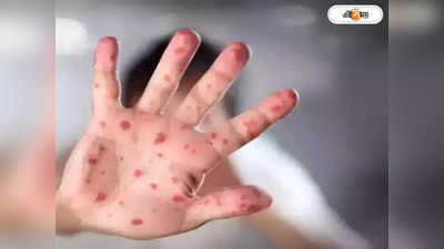 Monkeypox India: ৮ বছরের বালকের দেহে মাঙ্কিপক্সের উপসর্গ, বাড়ছে উদ্বেগ