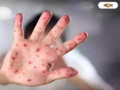 Monkeypox India: ৮ বছরের বালকের দেহে মাঙ্কিপক্সের উপসর্গ, বাড়ছে উদ্বেগ