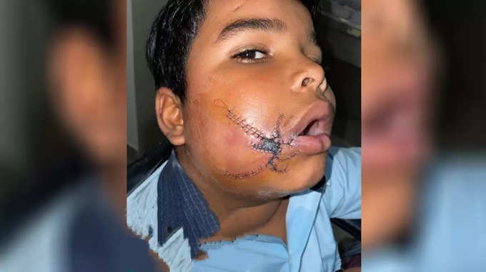 boy injured in blast of sparkling candle