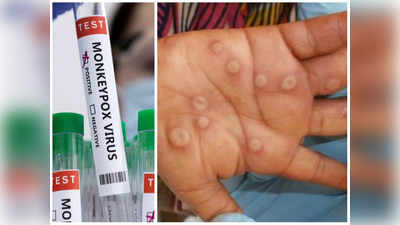 Monkeypox Death In India: దేశంలో తొలి మంకీపాక్స్ మరణం నమోదు.. కేరళలో 22 ఏళ్ల యువకుడి మృతి