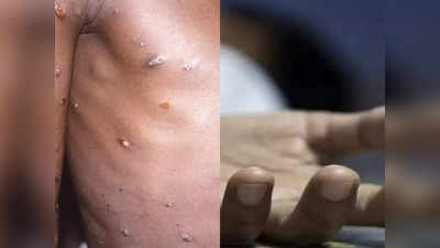 Monkeypox Death: भारत में मंकीपॉक्स से पहली मौत, UAE से केरल आया था युवक