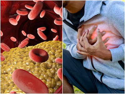 High Cholesterol Symptoms: কোলেস্টেরলের এই লক্ষণগুলি খালি চোখেই ধরা পড়ে! উপেক্ষা করলেই Heart Attack, Stroke-এর আশঙ্কা