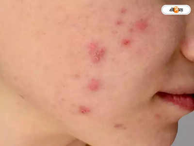 Monkeypox Virus: আমেরিকায় হু হু করে বাড়ছে মাঙ্কিপক্সের সংক্রমণ, আক্রান্তের সংখ্যা ছাড়াল ৫ হাজার!