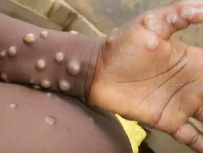 Monkeypox Death చనిపోయిన ఆ వ్యక్తికి మంకీపాక్స్ పాజిటివ్.. కేరళ ప్రభుత్వం