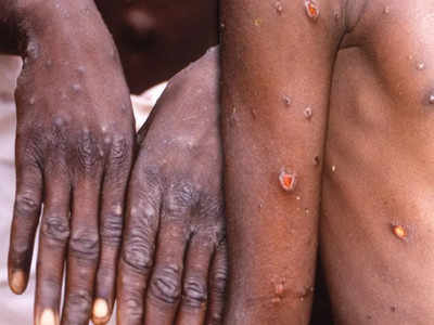 Monkeypox: அச்சுறுத்தும் குரங்கம்மை.. 21 நாட்கள் தனிமை - அரசு உத்தரவு!