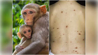 Monkeypox Virus: ভারতে বাড়ছে মাঙ্কিপক্স! উপসর্গ, চিকিৎসা, প্রতিরোধের পথ জানালেন চিকিৎসক