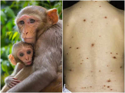 Monkeypox Virus: ভারতে বাড়ছে মাঙ্কিপক্স! উপসর্গ, চিকিৎসা, প্রতিরোধের পথ জানালেন চিকিৎসক